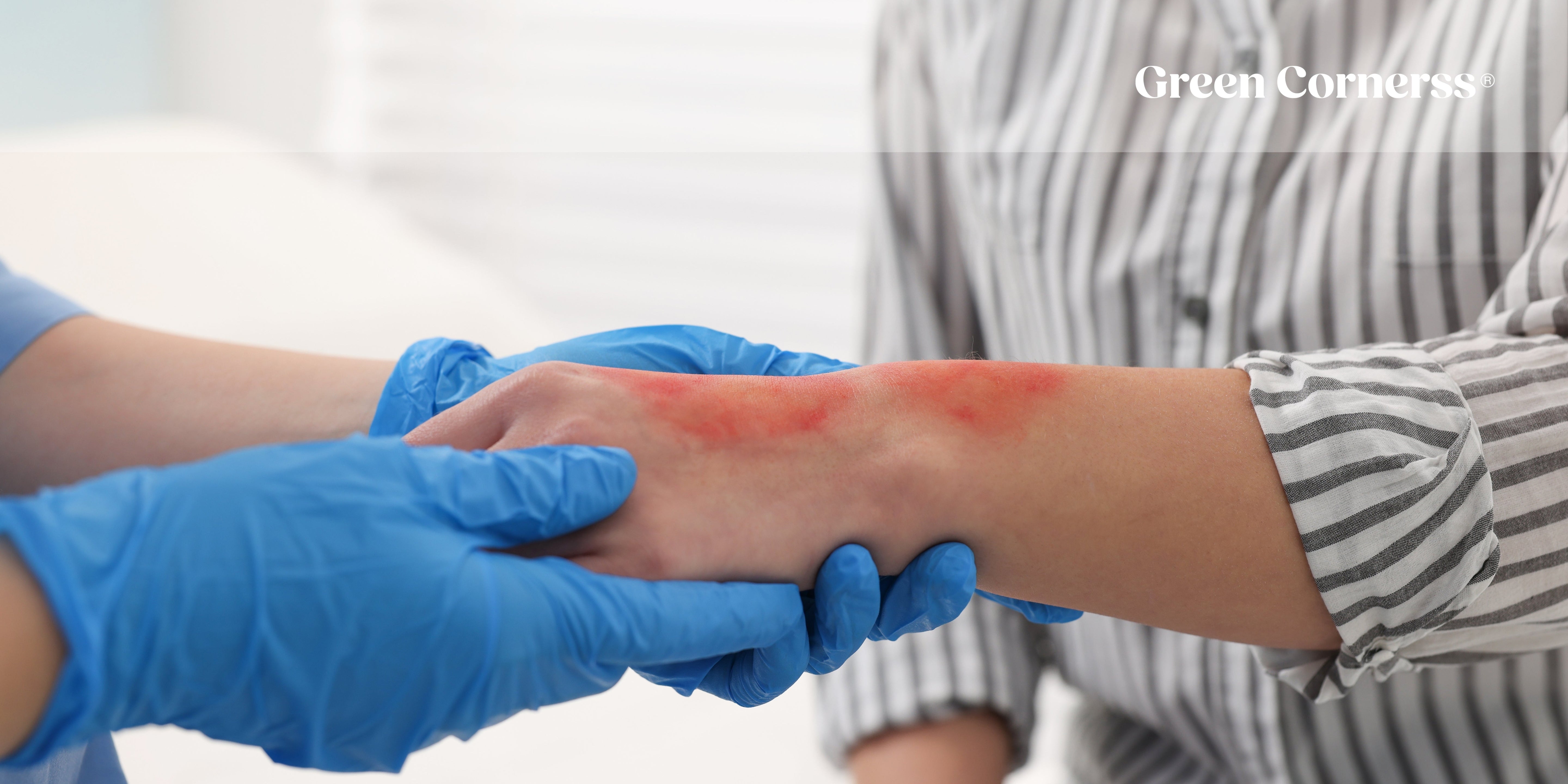Quemaduras En La Piel: Tratamiento Efectivo y Alivio Rápido