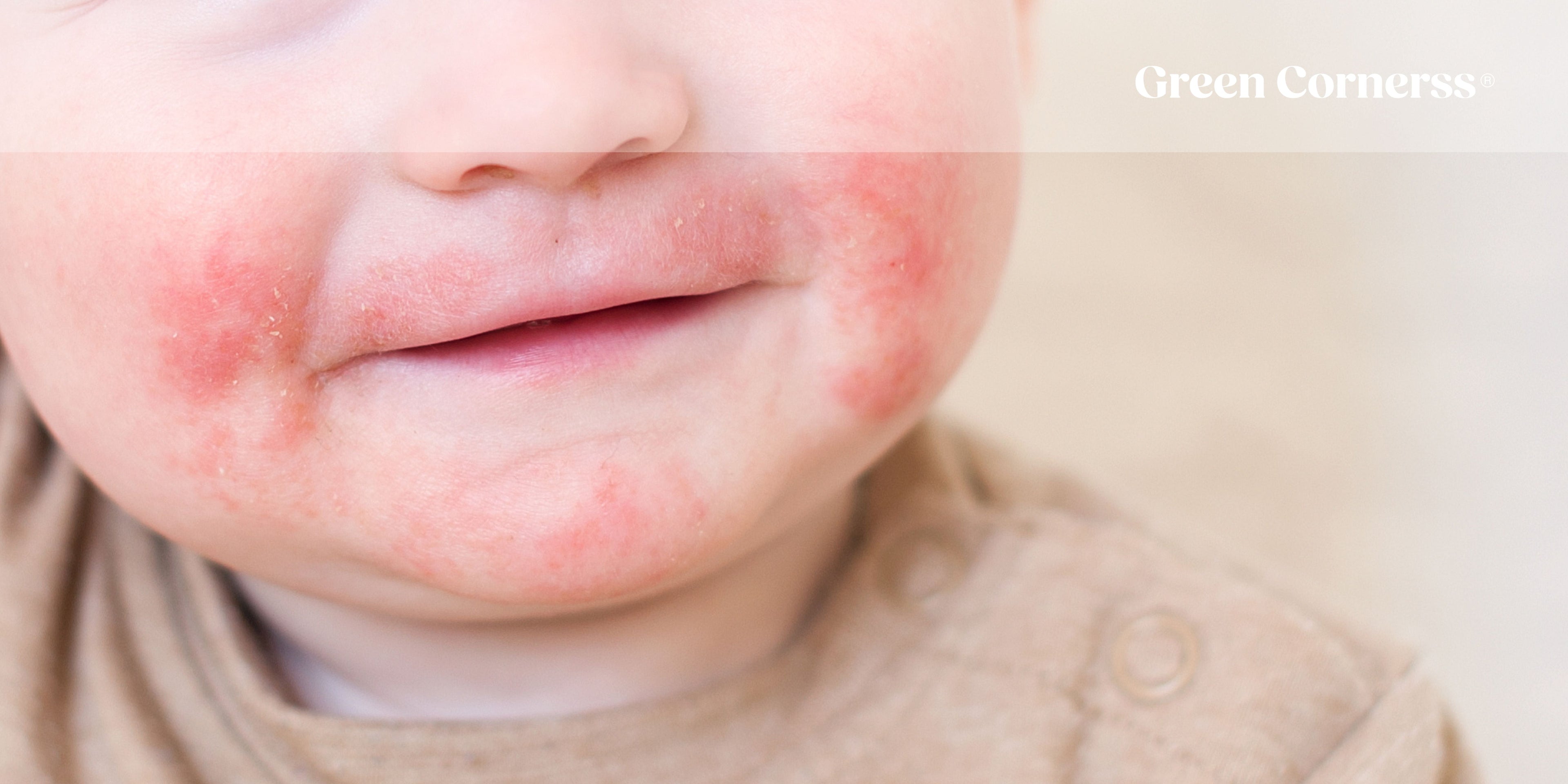 Dermatitis perioral: ¿Qué es y cómo puedo tratarla?