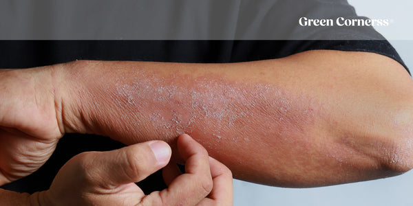 ¿Qué es la dermatitis atópica? Guía completa para entender esta enfermedad de la piel