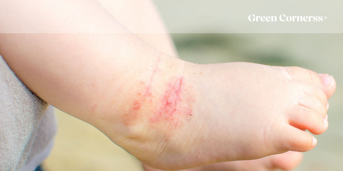 Mi hijo tiene dermatitis atópica: qué hacer y cómo calmar los brotes
