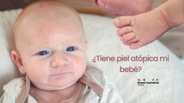 Cómo saber si mi bebé tiene piel atópica