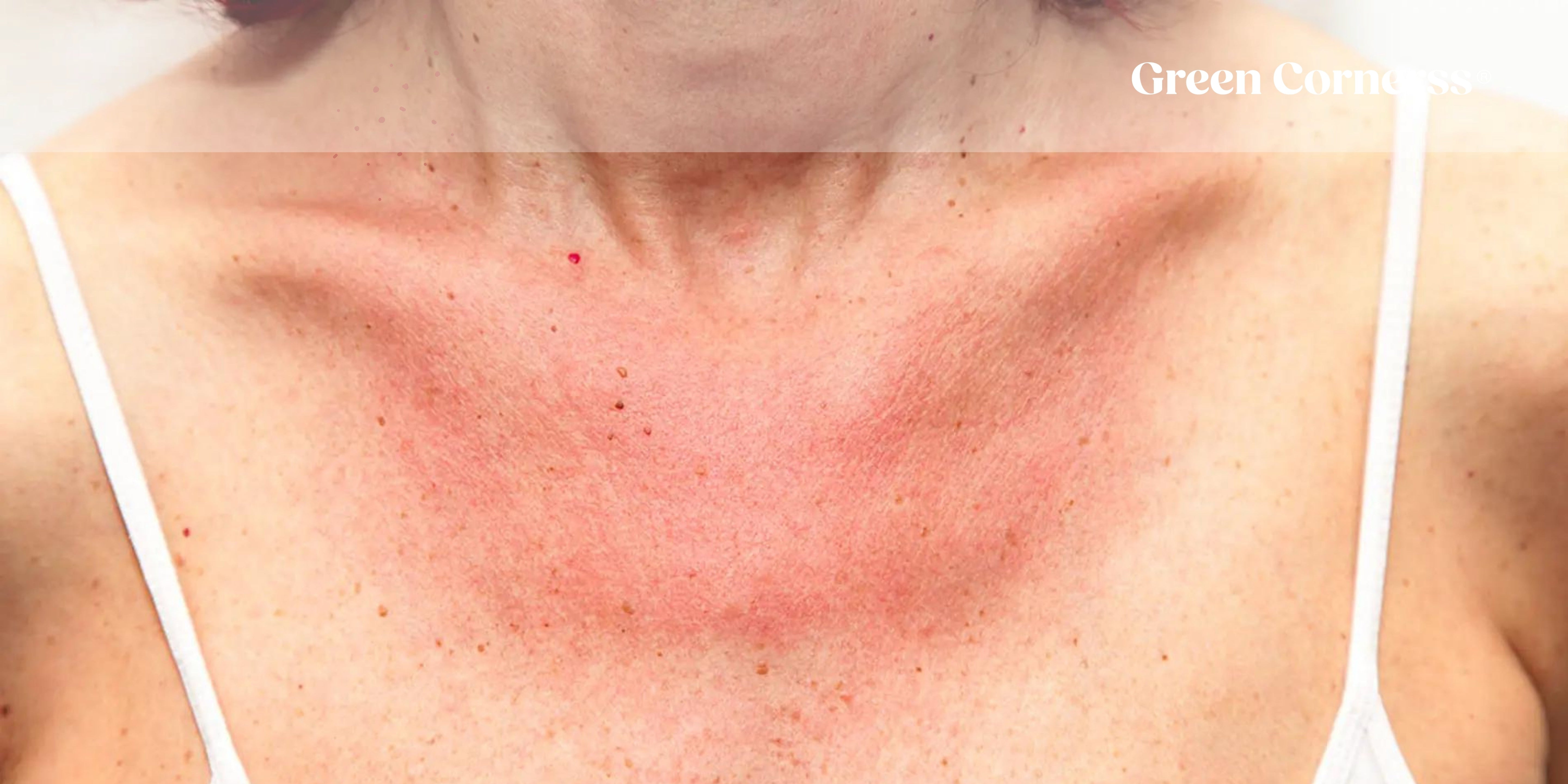 ALERGIA AL SOL: QUÉ ES, SÍNTOMAS Y TRATAMIENTO