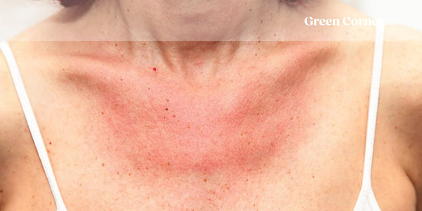 ALERGIA AL SOL: QUÉ ES, SÍNTOMAS Y TRATAMIENTO