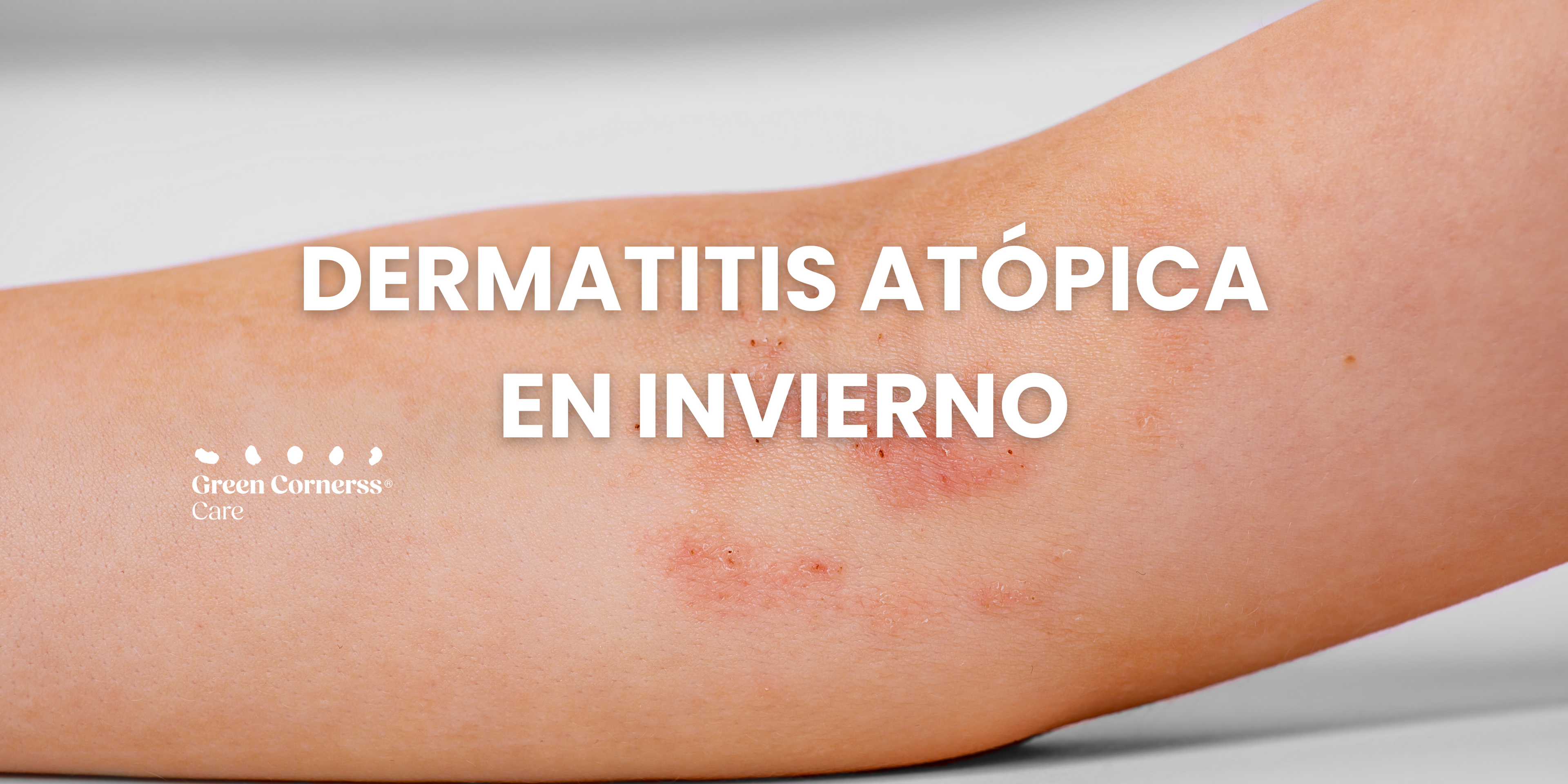 ¿Por qué empeora la dermatitis atópica en invierno?