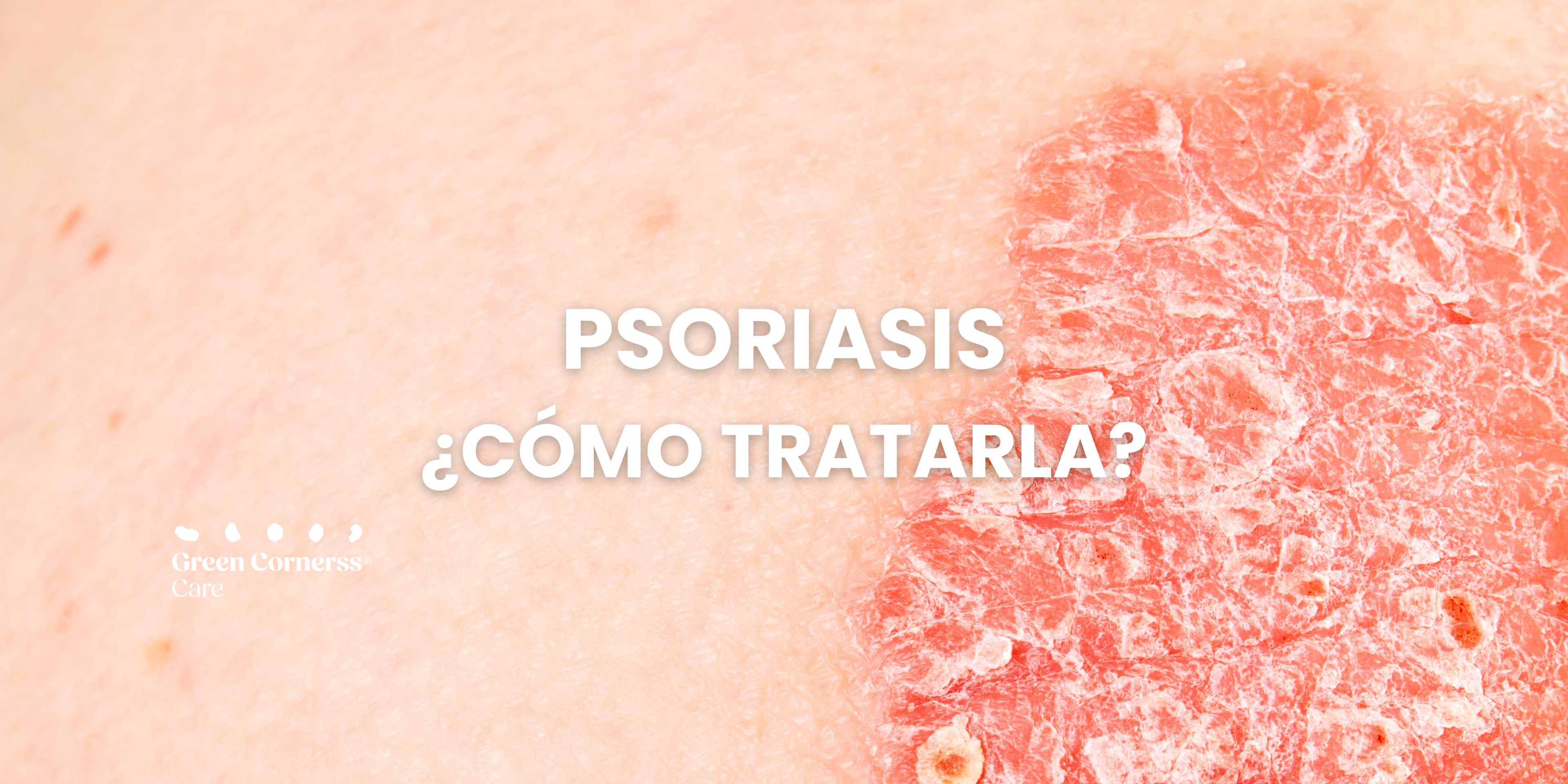 ¿Cómo tratar la Psoriasis en la piel?