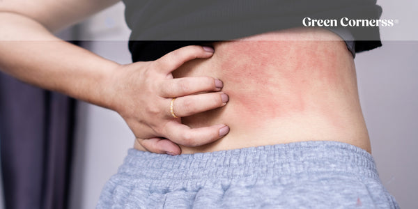 Dermatitis atópica en verano: Cómo afecta el calor y qué puedes hacer para aliviarla